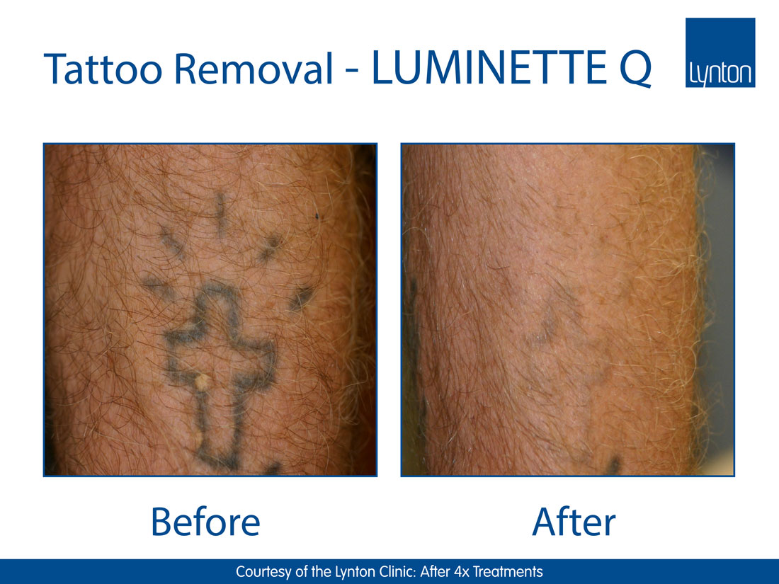 Lynton Laser tattoo removal Elite Beauty Clinic